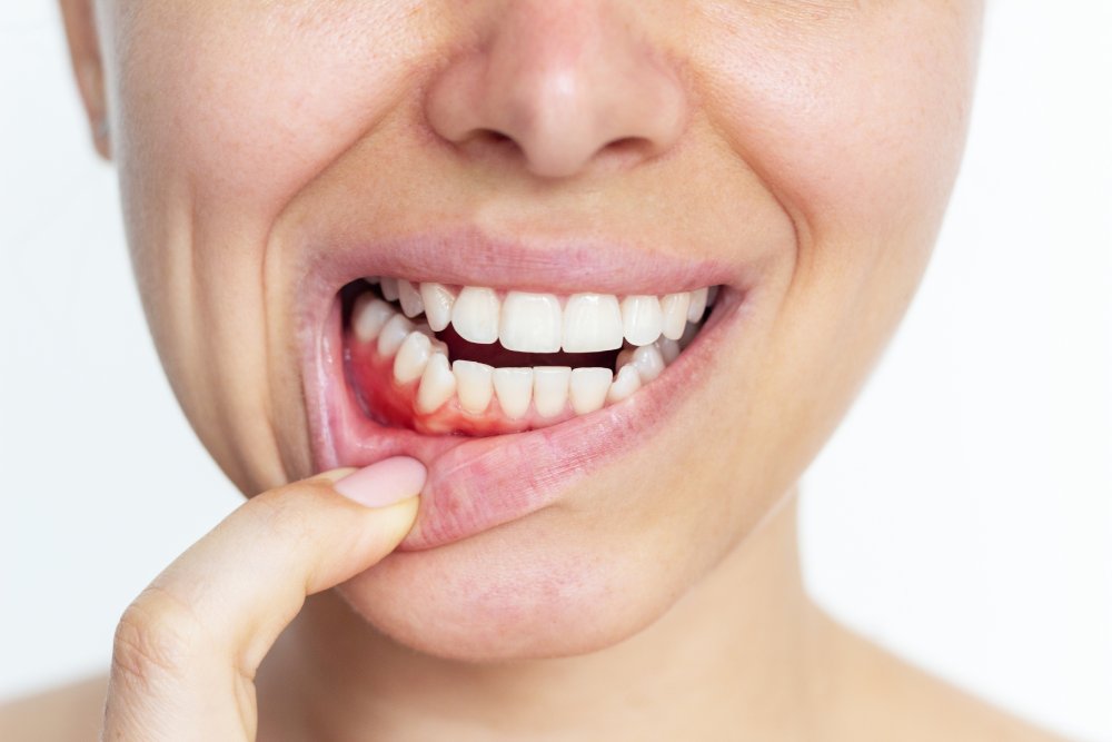 Gingivitis, gum inflammation. Cropped shot of a young woman showing red bleeding gums isolated on a white background. Close up. Dentistry, dental care