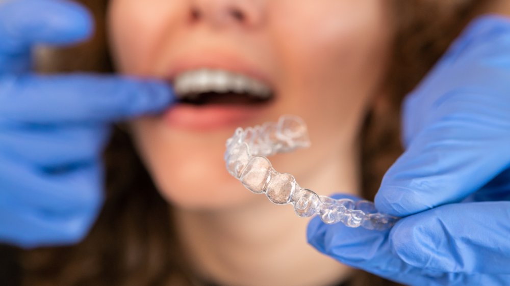 Orthodontist doctor in gloves putting silicone invisible transparent braces on woman's teeth in dentist clinic, mouth closeup view. Correcting teeth treatment and cure in dentistry.