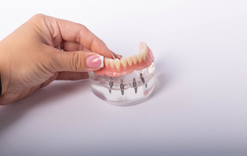 render of mandibular prosthesis all on 4 system supported by implants over white background